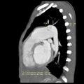 Aortopulmonary window, interrupted aortic arch and large PDA giving the descending aorta (Radiopaedia 35573-37077 E 1).jpg