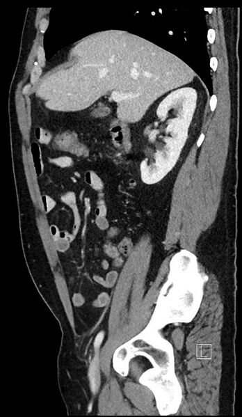File:Appendiceal diverticulitis (Radiopaedia 61802-69916 C 87).jpg