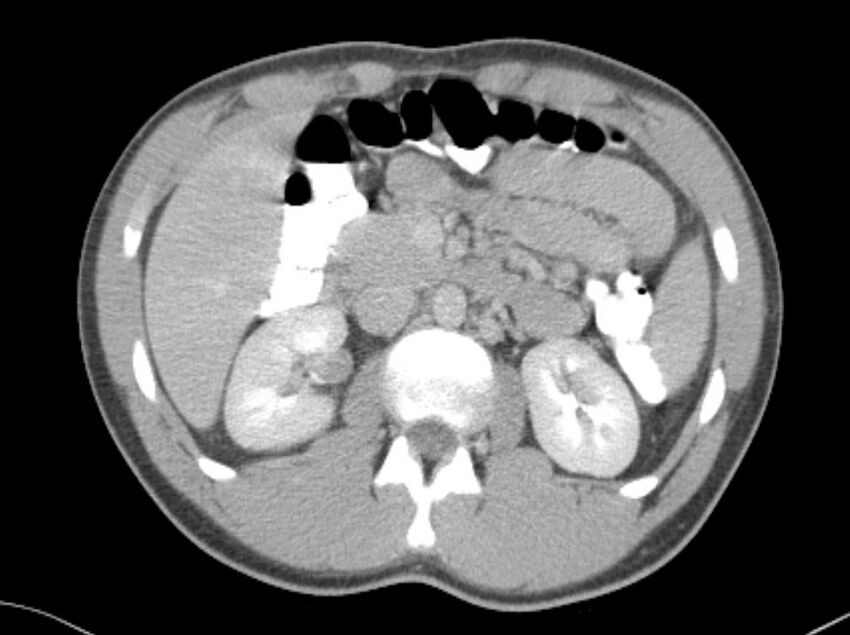 Appendicitis and incidental foregut duplication cyst (Radiopaedia 52962-58916 A 17).jpg