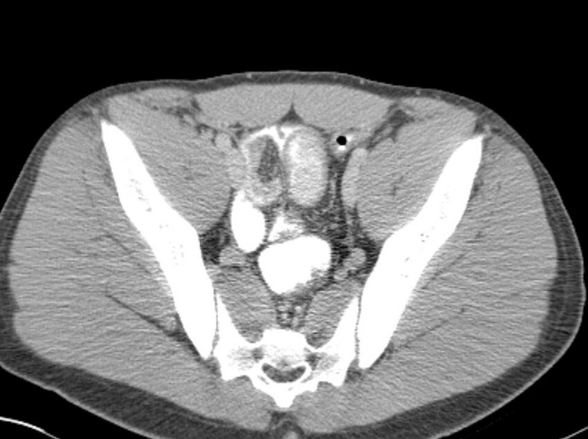 Appendicitis and incidental foregut duplication cyst (Radiopaedia 52962-58916 A 82).jpg
