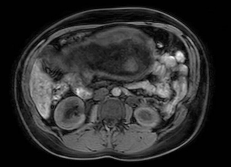 File:Appendicitis in gravida (MRI) (Radiopaedia 89433-106395 Axial DIXON 57).jpg