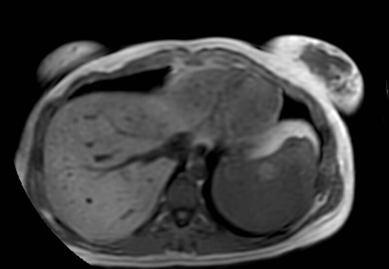 File:Appendicitis in gravida (MRI) (Radiopaedia 89433-106395 Axial T1 in-phase 3).jpg