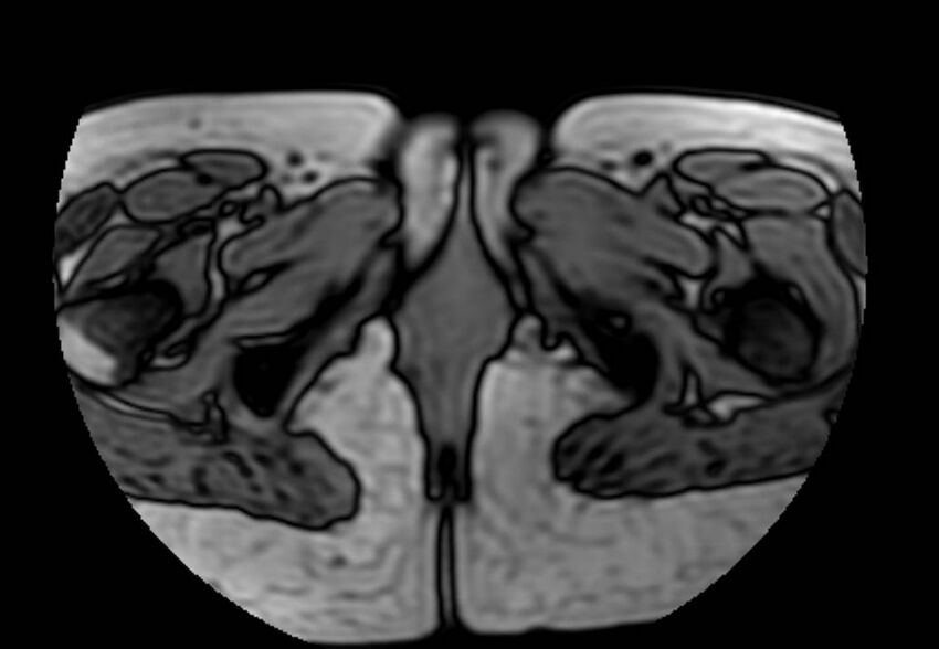 Appendicitis in gravida (MRI) (Radiopaedia 89433-106395 D 75).jpg