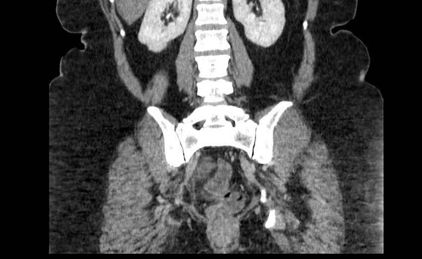 Appendix mucocele (Radiopaedia 41222-44033 B 69).jpg