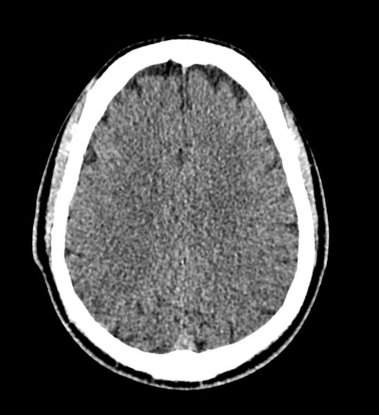 File:Arachnoid cyst of the ambient cistern (Radiopaedia 81301-94986 Axial non-contrast 48).jpg