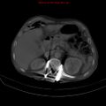 Arachnoiditis ossificans (Radiopaedia 51394-57136 Axial bone window 9).jpg