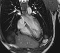 Arrhythmogenic right ventricular cardiomyopathy (Radiopaedia 39806-42237 D 127).jpg