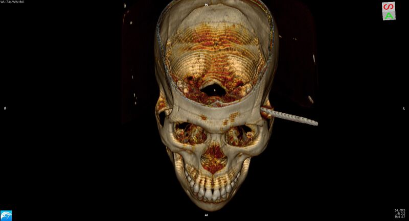 File:Arrow injury to the head (Radiopaedia 75266-86388 3D vertical 12).jpg