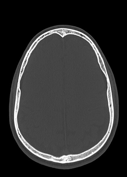 File:Arrow injury to the head (Radiopaedia 75266-86388 Axial bone window 90).jpg