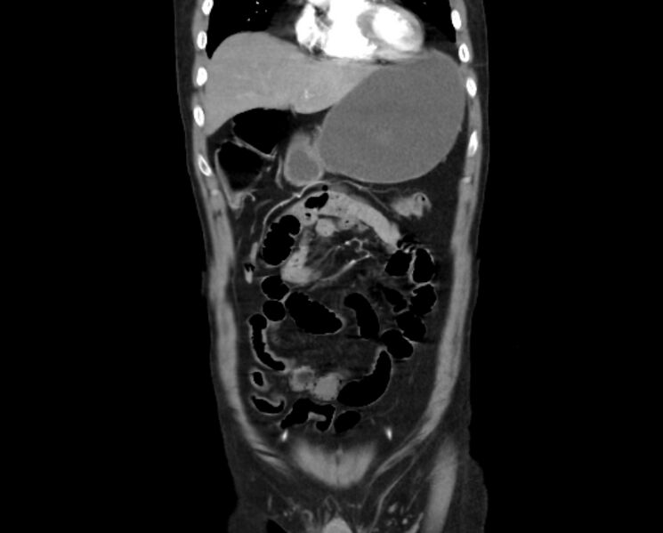 File:Arterial occlusive mesenteric ischemia (Radiopaedia 84641-100060 B 14).jpg