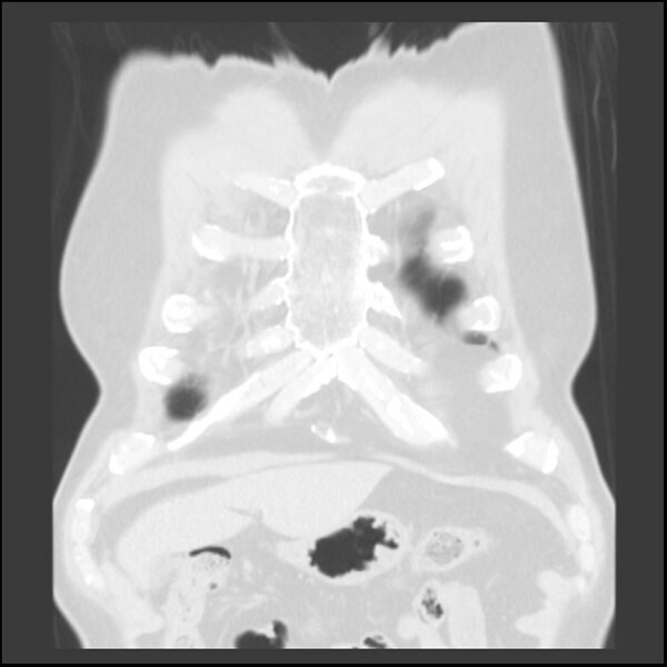 File:Asbestos-related pleural plaques (Radiopaedia 39069-41255 Coronal lung window 79).jpg