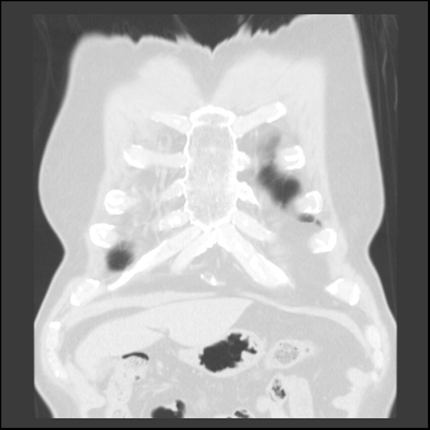 Asbestos-related pleural plaques (Radiopaedia 39069-41255 Coronal lung window 79).jpg