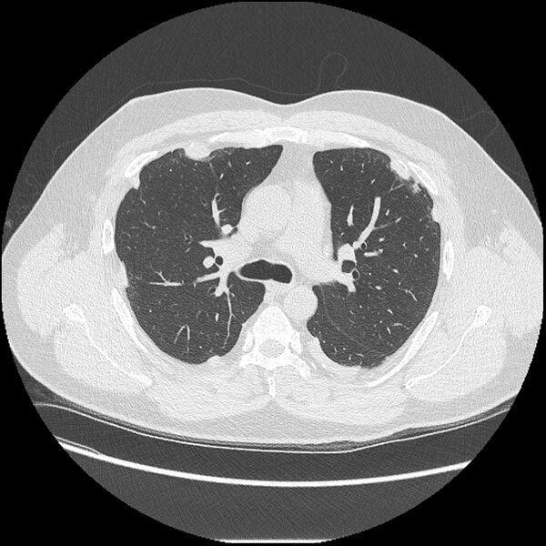 File:Asbestosis (Radiopaedia 45002-48961 Axial lung window 20).jpg