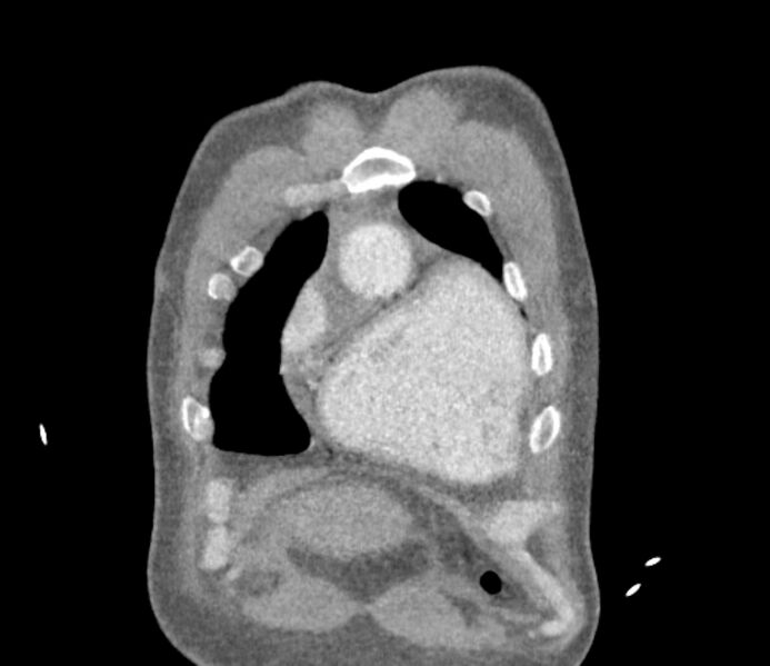 File:Ascending aortic aneurysm (Radiopaedia 86279-102297 B 4).jpg