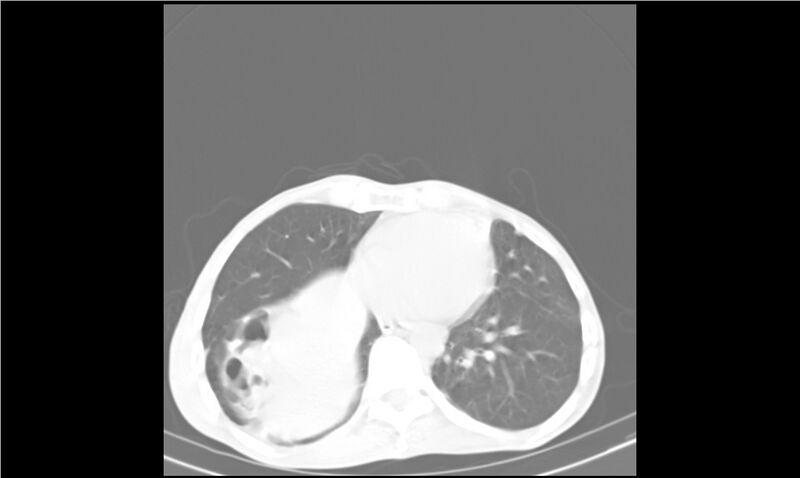 File:Aspergilloma (Radiopaedia 20788-20701 Axial lung window 25).jpg