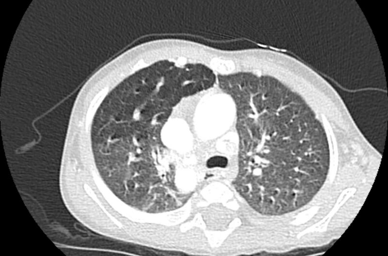 File:Asplenia syndrome (Radiopaedia 73083-83792 Axial lung window 22).jpg