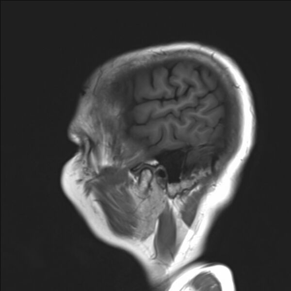 File:Atlanto-occipital assimilation with basilar invagination (Radiopaedia 70122-80157 Sagittal T1 2).jpg