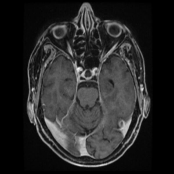 File:Atypical meningioma (Radiopaedia 45535-49629 Axial T1 C+ 30).jpg