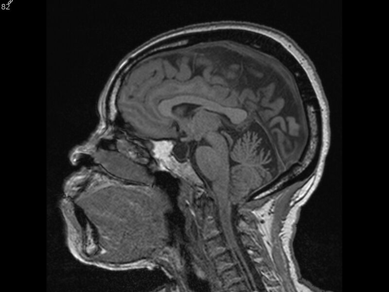 File:Atypical meningioma - intraosseous (Radiopaedia 64915-74572 Sagittal T1 82).jpg