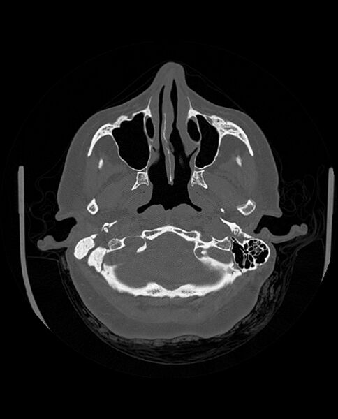 File:Automastoidectomy with labyrinthine fistula (Radiopaedia 84143-99411 Axial non-contrast 62).jpg