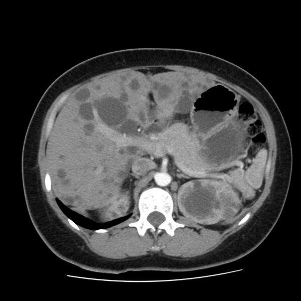 File:Autosomal dominant polycystic kidney disease (Radiopaedia 23061-23093 B 21).jpg