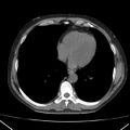 Autosomal dominant polycystic kidney disease (Radiopaedia 36539-38101 Axial non-contrast 1).jpg