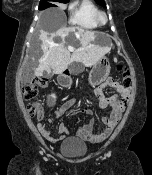 File:Autosomal dominant polycystic kidney disease (Radiopaedia 57124-64017 B 24).jpg