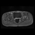 Avascular necrosis of the hip (Radiopaedia 29563-30067 Axial T1 C+ fat sat 6).jpg