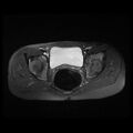 Avascular necrosis of the hip (Radiopaedia 29563-30067 Axial T2 fat sat 4).jpg