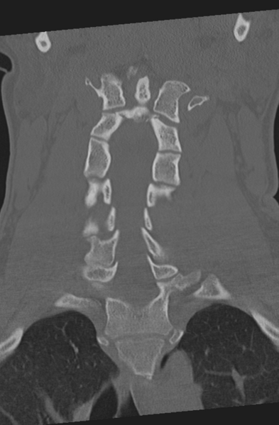 File:Axis peg fracture (type 3) and atlas lateral mass (type 4) fracture (Radiopaedia 37474-39324 Coronal bone window 23).png