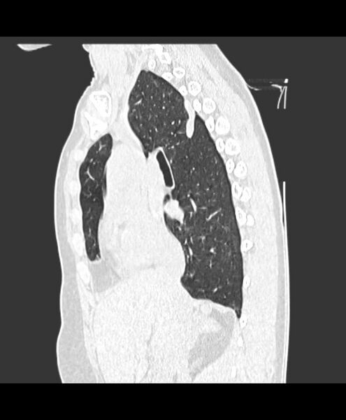 File:Azygos fissure and azygos lobe (Radiopaedia 41841-44832 Sagittal lung window 8).jpg