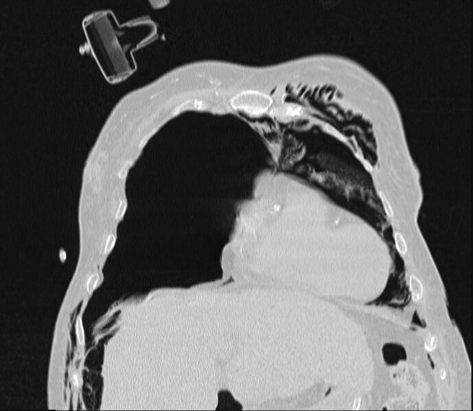 File:Barotrauma due to mechanical ventilation (Radiopaedia 28079-28336 Coronal lung window 27).jpg