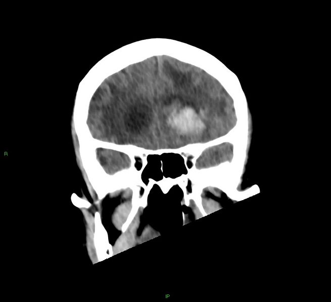 File:Basal ganglia hemorrhage (Radiopaedia 58766-65988 Coronal non-contrast 47).jpg