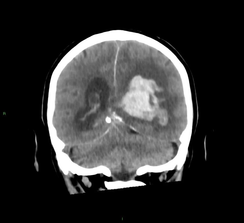 Basal ganglia hemorrhage (Radiopaedia 58775-66008 Coronal non-contrast 25).jpg