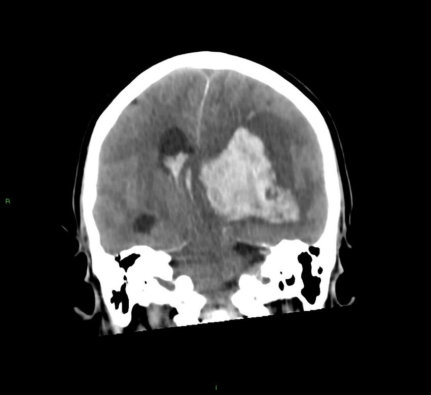 Basal ganglia hemorrhage (Radiopaedia 58775-66008 Coronal non-contrast 31).jpg