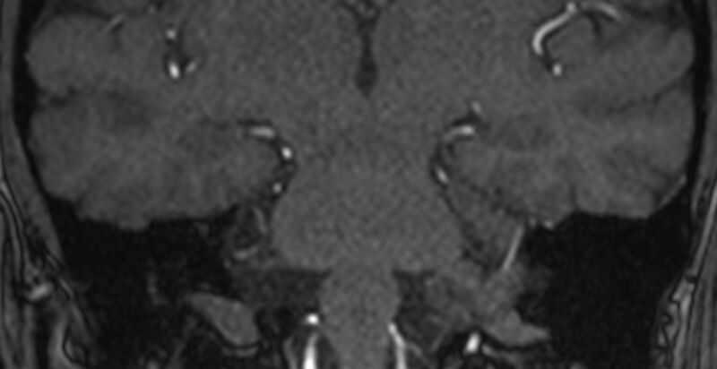 File:Basilar artery fenestration (Radiopaedia 74537-85455 Coronal MRA TOF 80).jpg