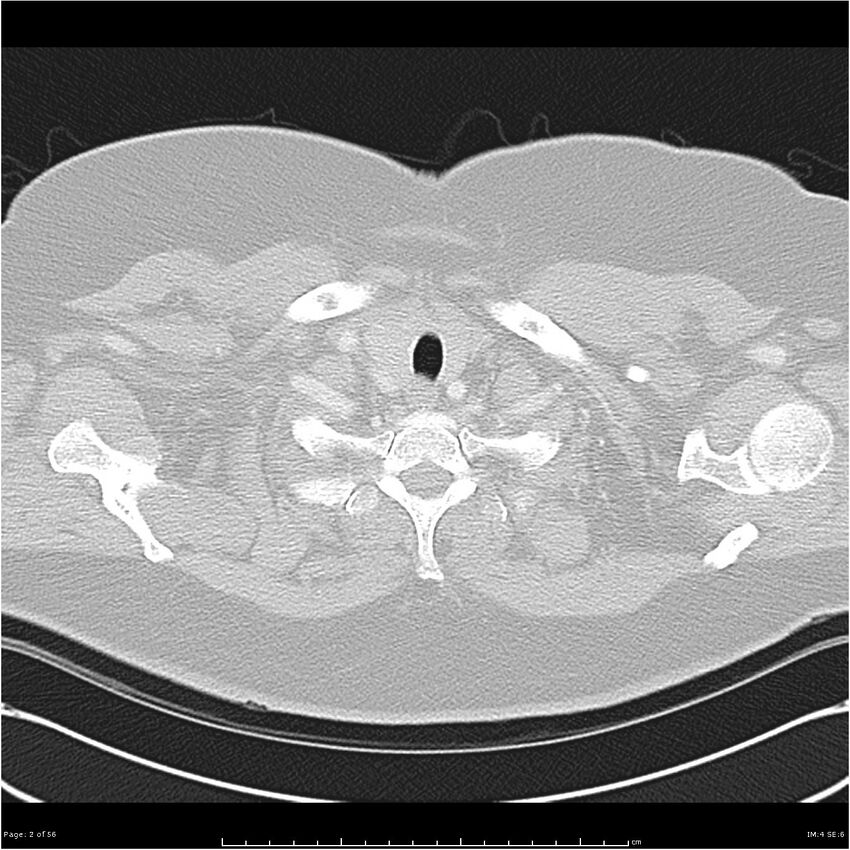 Benign metastasizing leiomyoma (Radiopaedia 26803-26962 Axial lung window 2).jpg
