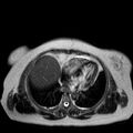 Benign seromucinous cystadenoma of the ovary (Radiopaedia 71065-81300 Axial T2 24).jpg