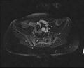 Bicornuate bicollis uterus (Radiopaedia 61626-69616 Axial PD fat sat 9).jpg