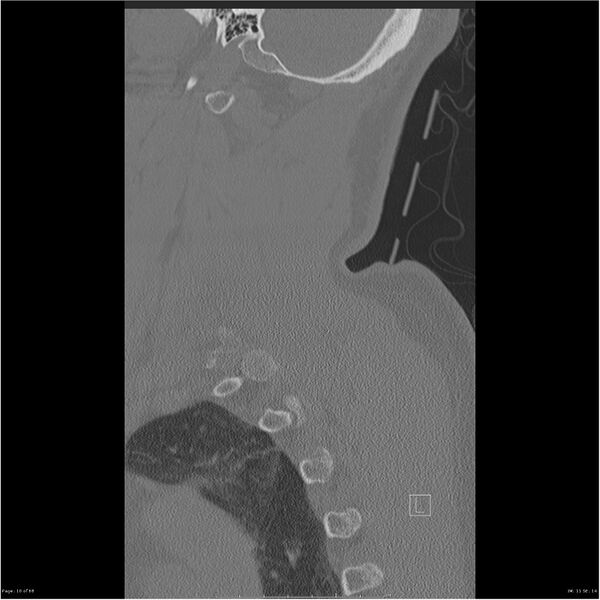 File:Bilateral cervical ribs (Radiopaedia 25868-26017 Sagittal bone window 10).jpg