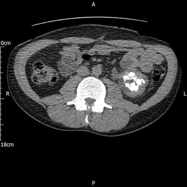 File:Bilateral medullary nephrocalcinosis with ureteric calculi (Radiopaedia 71269-81569 Axial non-contrast 62).jpg