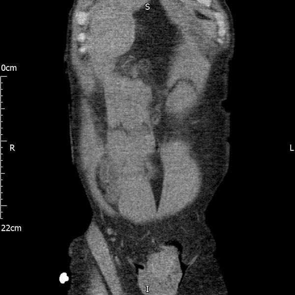 File:Bilateral medullary nephrocalcinosis with ureteric calculi (Radiopaedia 71269-81569 Coronal non-contrast 11).jpg
