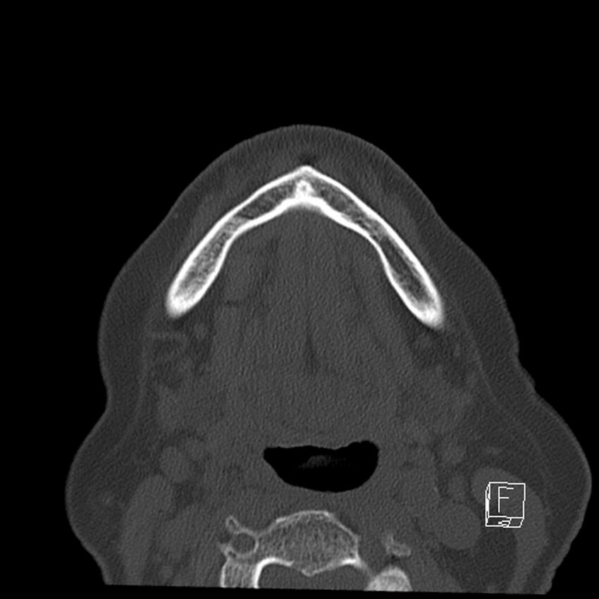 Bilateral palatine tonsilloliths on OPG and CT (Radiopaedia 75167-86247 Axial bone window 53).jpg