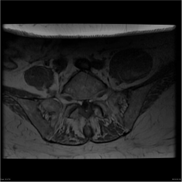 File:Bilateral psoas hematomas (Radiopaedia 24057-24280 T1 16).jpg