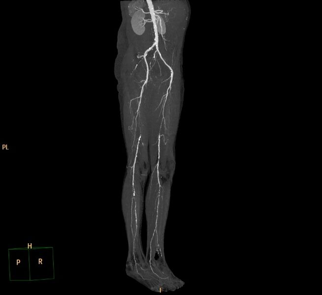 File:Bilateral superficial femoral arterial occlusion (Radiopaedia 25682-25857 3D MIP 10).jpg