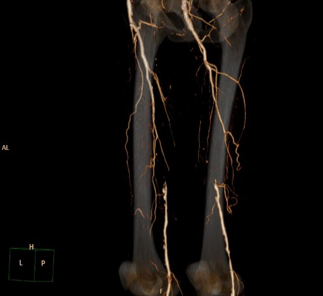 File:Bilateral superficial femoral arterial occlusion (Radiopaedia 25682-25857 3D VR 14).jpg