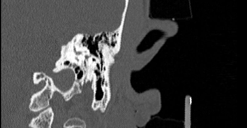 File:Bilateral temporal bone fractures (Radiopaedia 29482-29970 Coronal 198).jpg