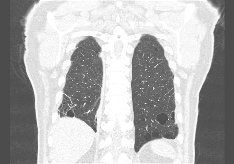 File:Birt-Hogg-Dubé syndrome (Radiopaedia 52578-58491 Coronal lung window 53).jpg