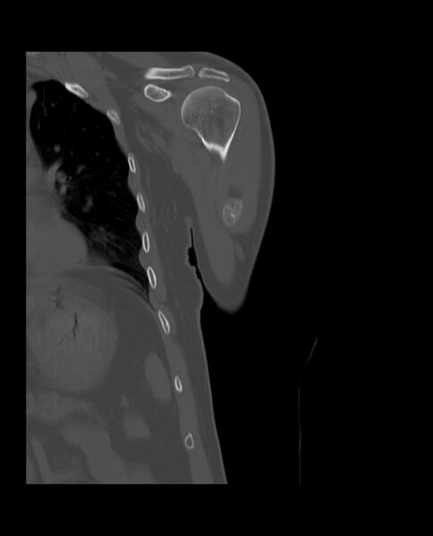 File:Bizarre parosteal osteochondromatous proliferation (Radiopaedia 84221-99501 Coronal bone window 9).jpg