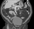 Bladder papillary urothelial carcinoma (Radiopaedia 48119-52951 C 30).png